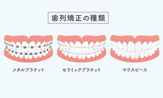 インプラントとは？